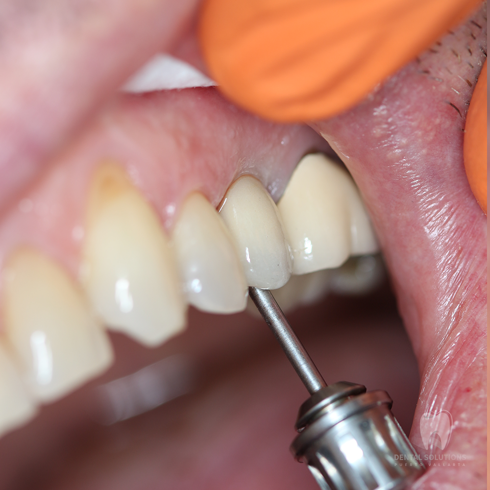The most common types of implants are the unitary dental implants