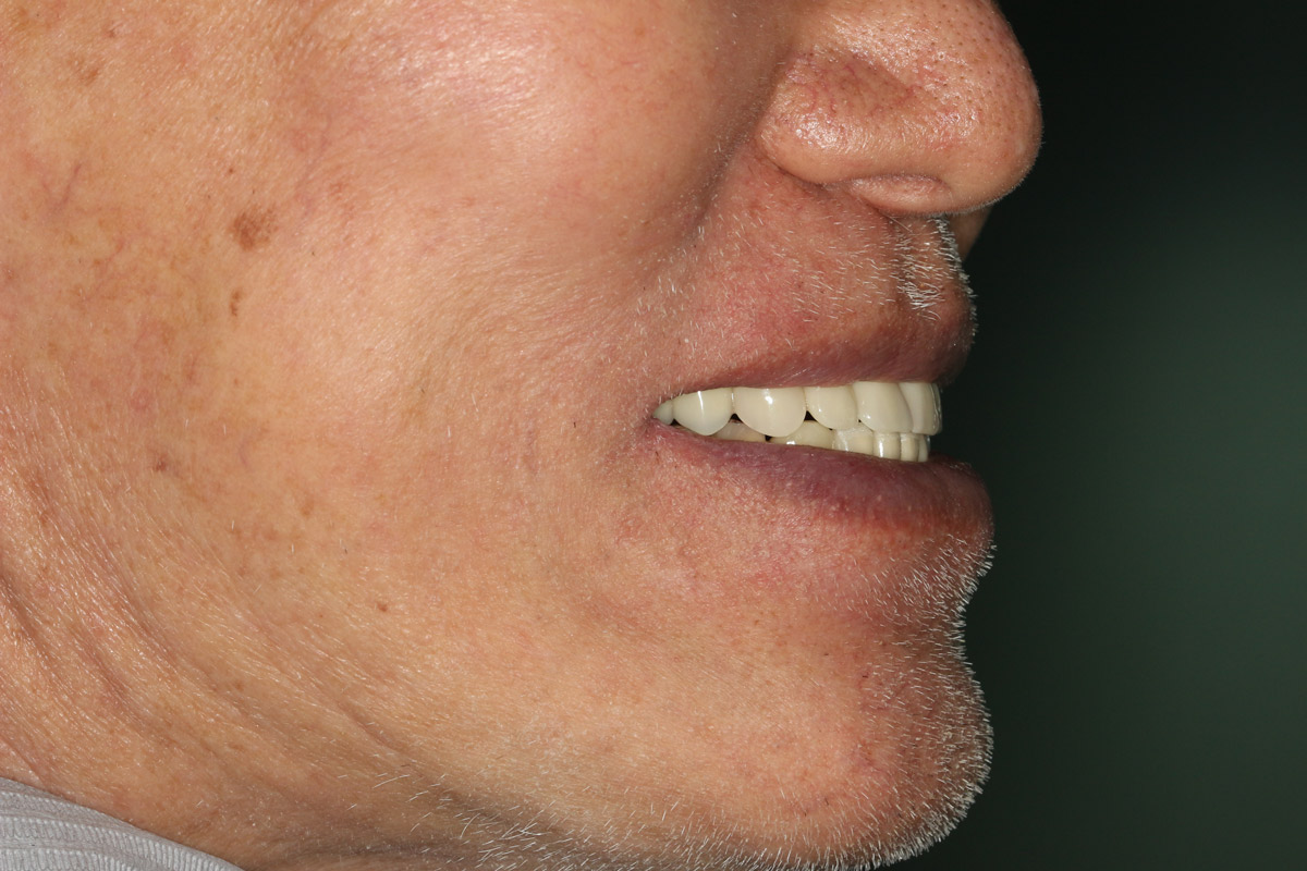 Full denture supported by implants.
