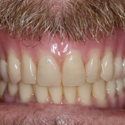 Dental Implants (after)