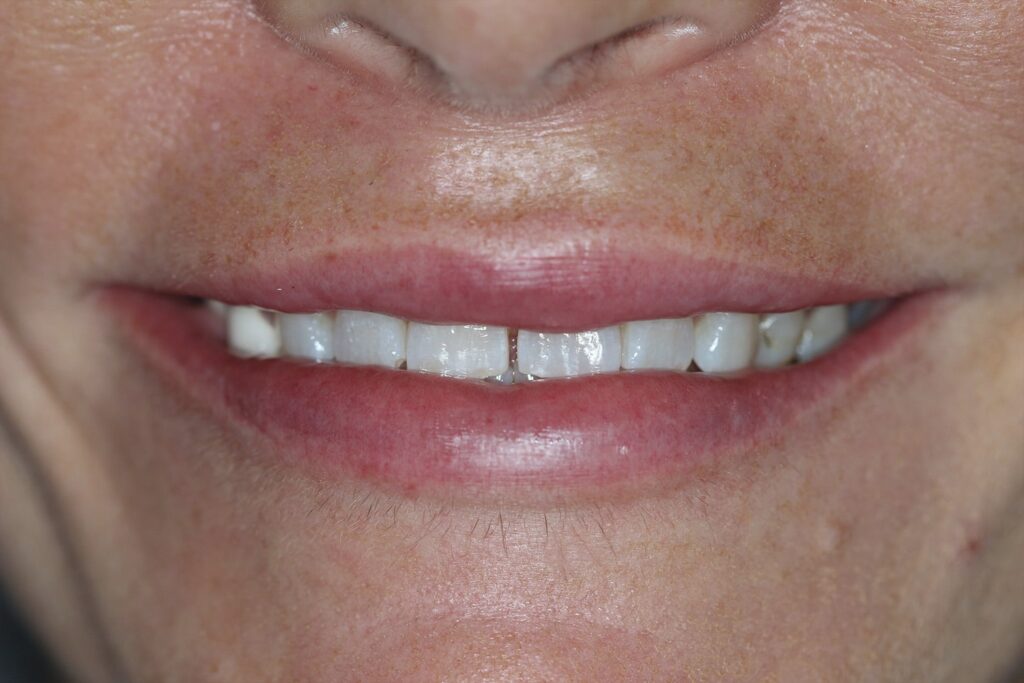 Dental Veneers (before)