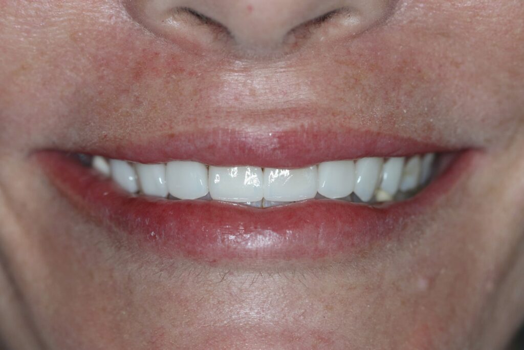 Dental Veneers (after)