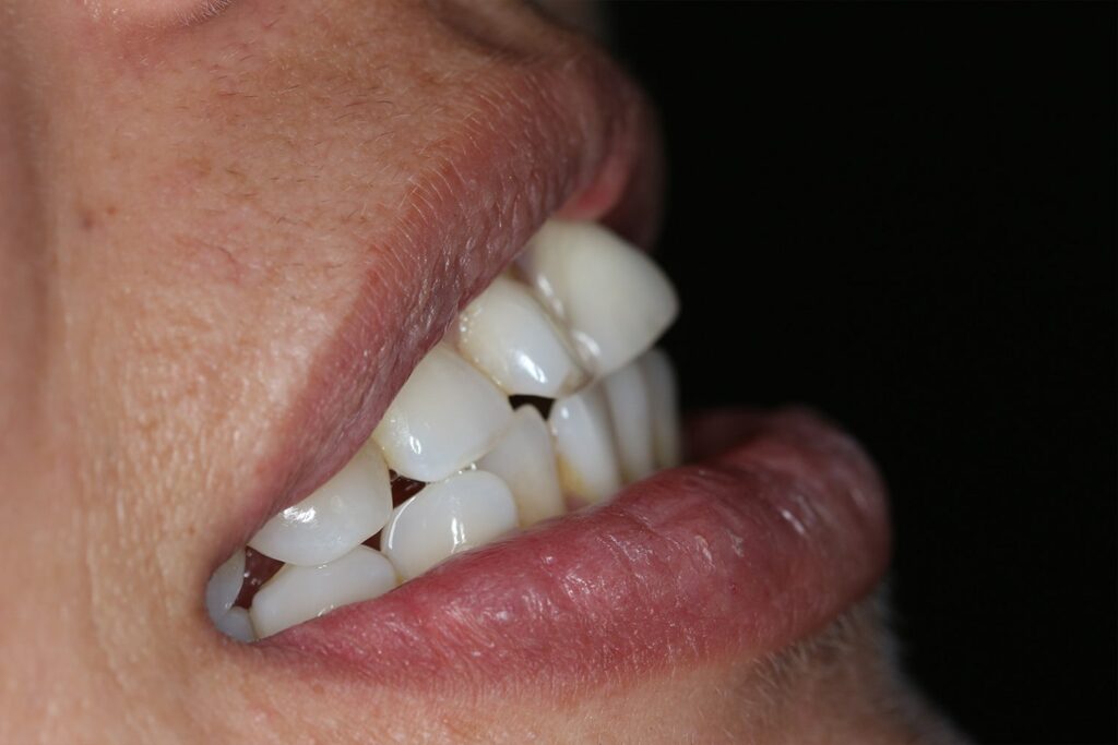 Dental Veneers (before)