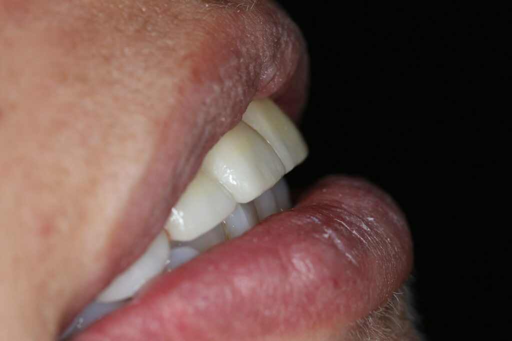 Dental Veneers (after)