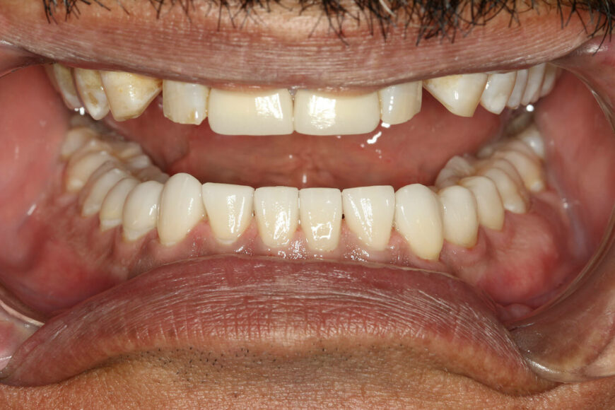 Severe tooth wear restorative treatment