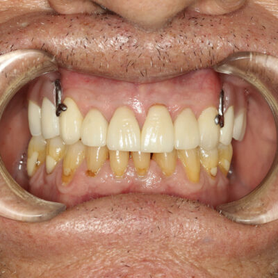 Dental restorations