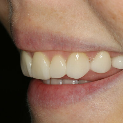 Smile design