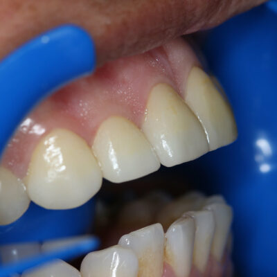 Veneers and fixed bridge made of porcelain