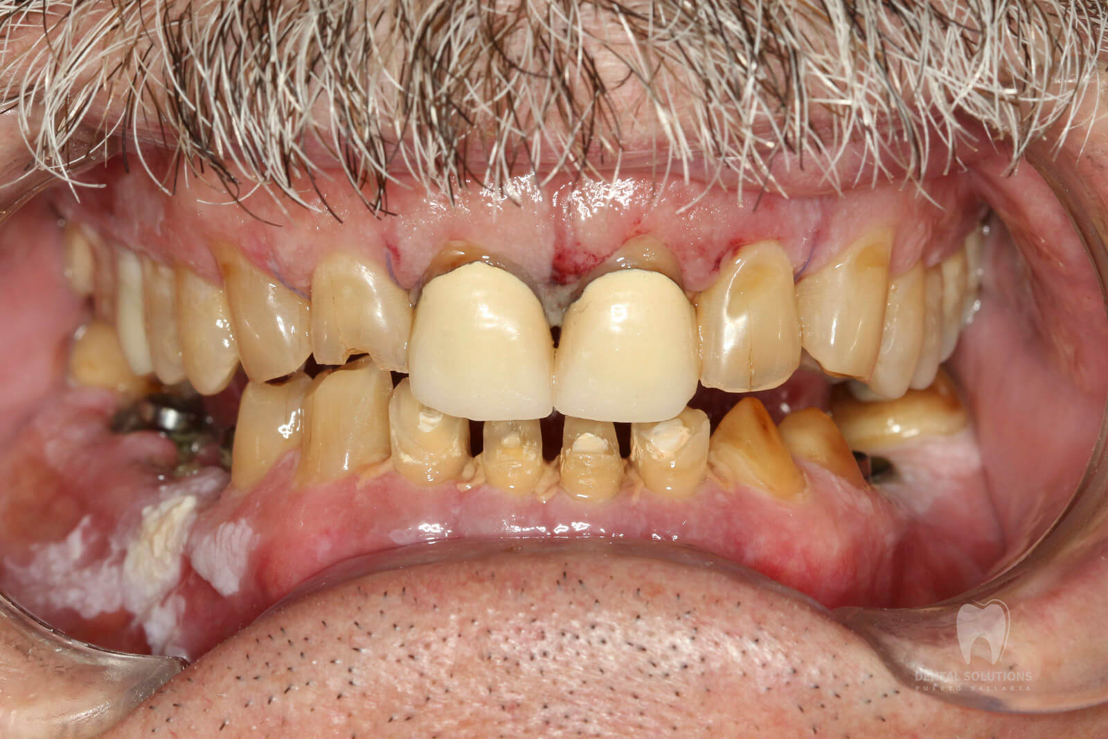 severe worn teeth