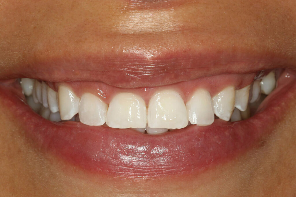 Zoom whitening (after treatment)