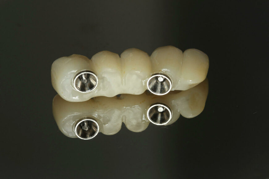 Restorative Dentistry in Mexico: A Convenient Solution for Your Oral Health