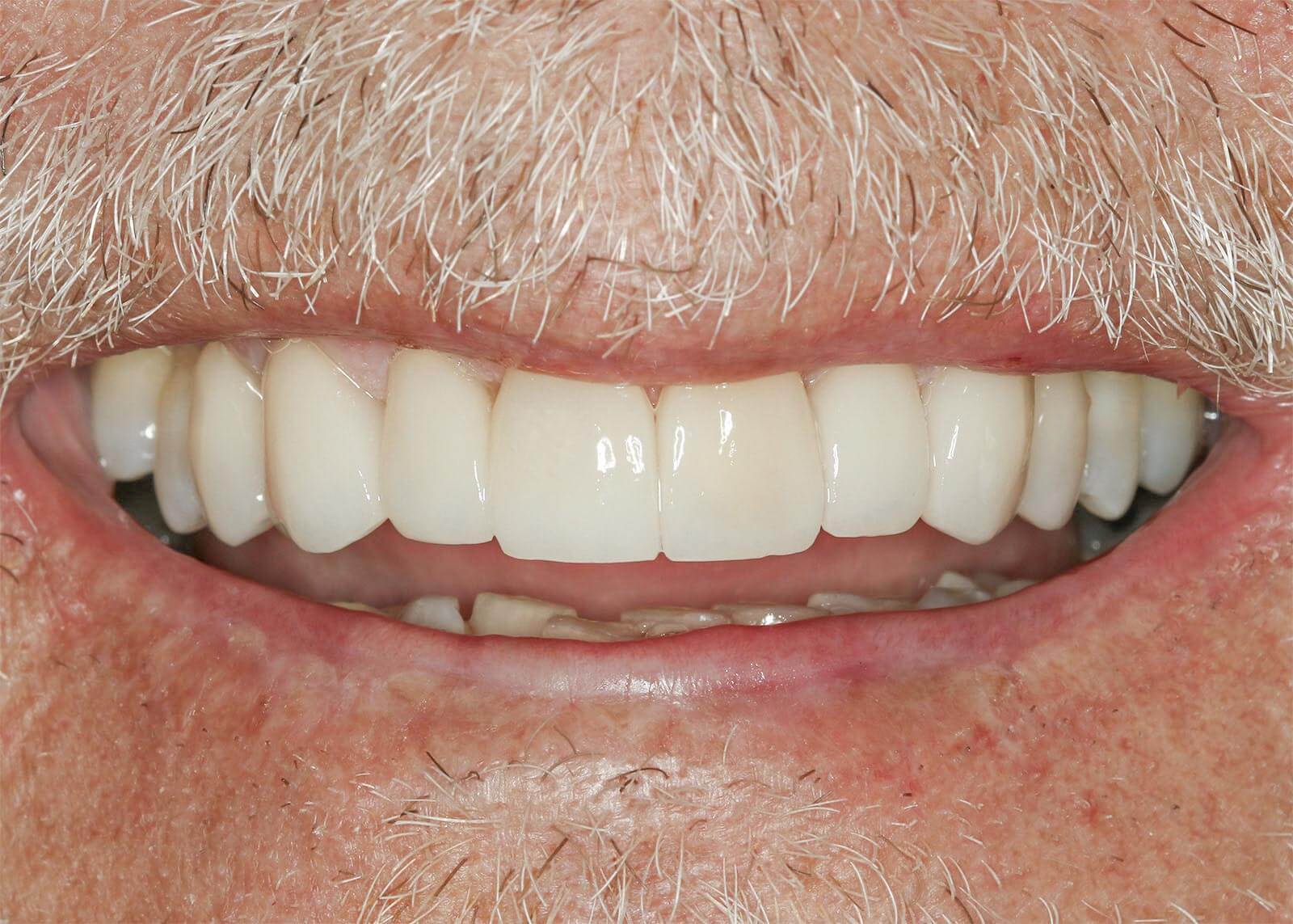 Dental Veneers