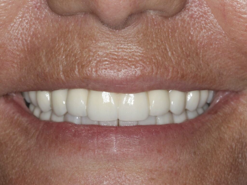 Full-mouth dental implants