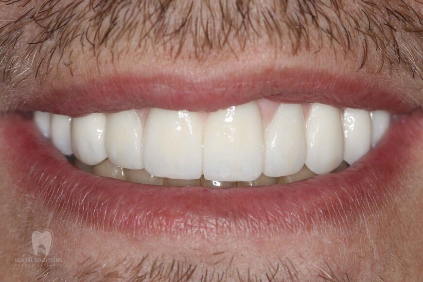 Dental Implants in Mexico: everything you need to know