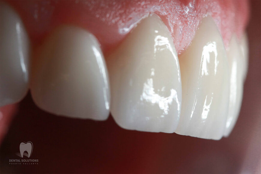 What are veneers? A look into smile design and digital dentistry