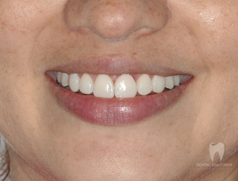 Here is the result from composite resin veneers.