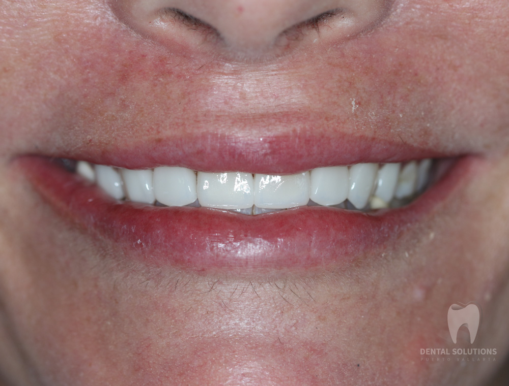 A smile with upper teeth veneers